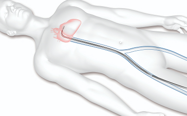 Access through a vein