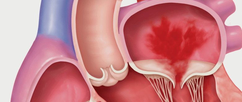 Secondary mitral regurgitation