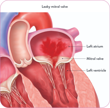 Leaky mitral valve showing blood flowing backward from the left ventricle into the left atrium through an improperly closed mitral valve; labeled structures include the left atrium, mitral valve, and left ventricle